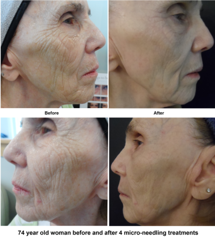 004ProcellAgingLooseSkin